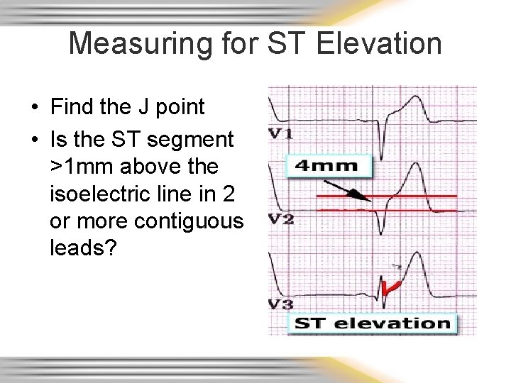 Measuring for ST Elevation • Find the J point • Is the ST segment