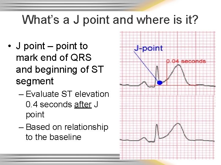 What’s a J point and where is it? • J point – point to