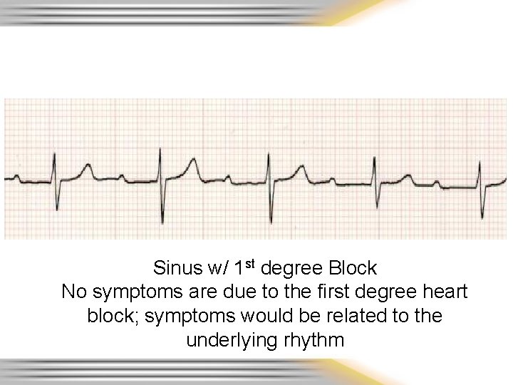 Sinus w/ 1 st degree Block No symptoms are due to the first degree