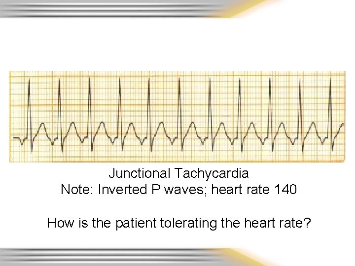 Junctional Tachycardia Note: Inverted P waves; heart rate 140 How is the patient tolerating