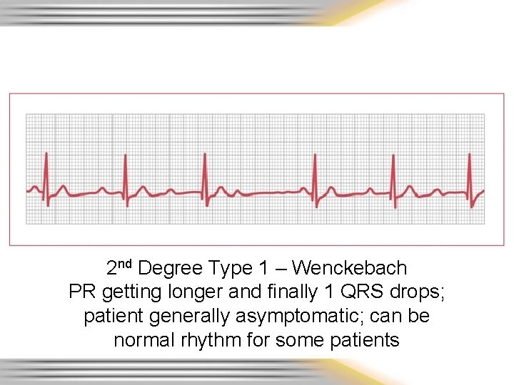 2 nd Degree Type 1 – Wenckebach PR getting longer and finally 1 QRS