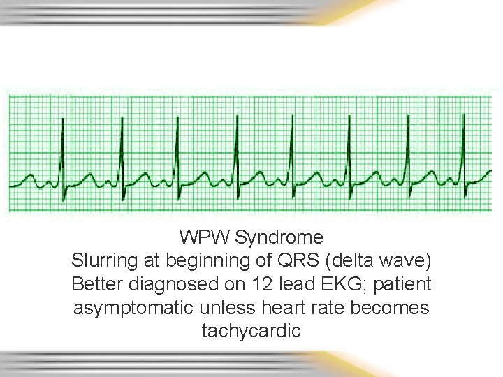 WPW Syndrome Slurring at beginning of QRS (delta wave) Better diagnosed on 12 lead