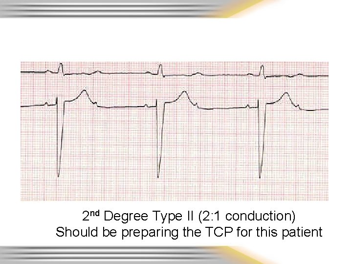 2 nd Degree Type II (2: 1 conduction) Should be preparing the TCP for