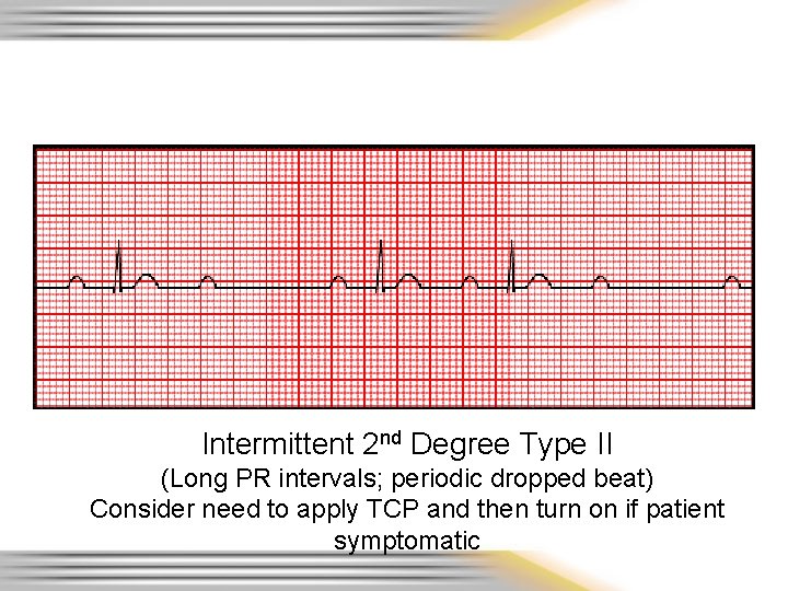 Intermittent 2 nd Degree Type II (Long PR intervals; periodic dropped beat) Consider need