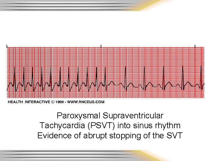 Paroxysmal Supraventricular Tachycardia (PSVT) into sinus rhythm Evidence of abrupt stopping of the SVT