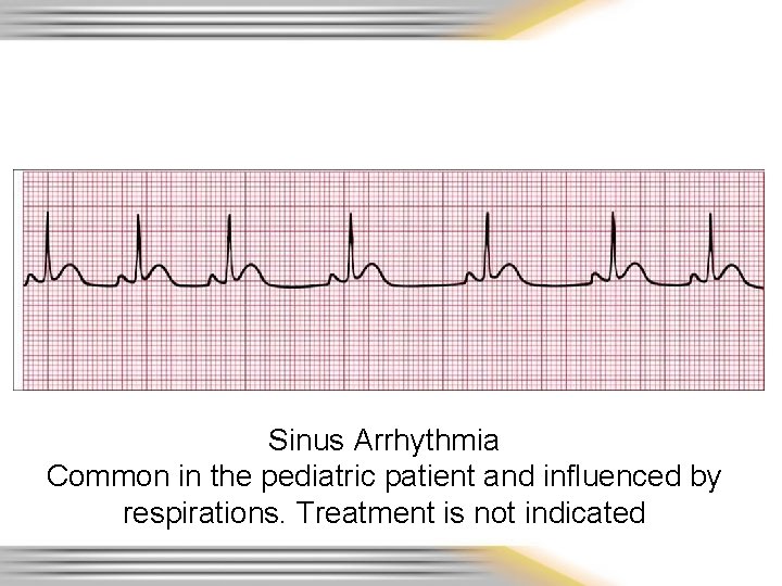 Sinus Arrhythmia Common in the pediatric patient and influenced by respirations. Treatment is not