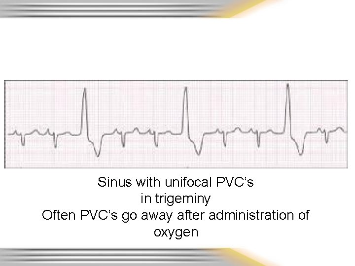 Sinus with unifocal PVC’s in trigeminy Often PVC’s go away after administration of oxygen