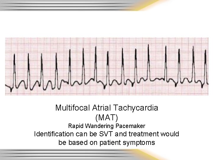 Multifocal Atrial Tachycardia (MAT) Rapid Wandering Pacemaker Identification can be SVT and treatment would