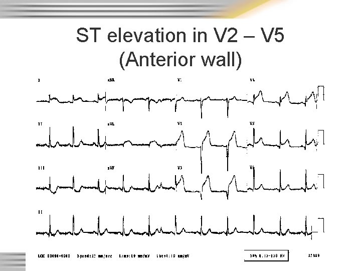 ST elevation in V 2 – V 5 (Anterior wall) 