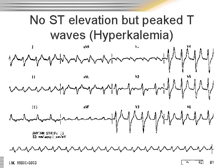 No ST elevation but peaked T waves (Hyperkalemia) 