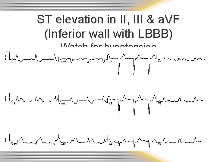 ST elevation in II, III & a. VF (Inferior wall with LBBB) Watch for