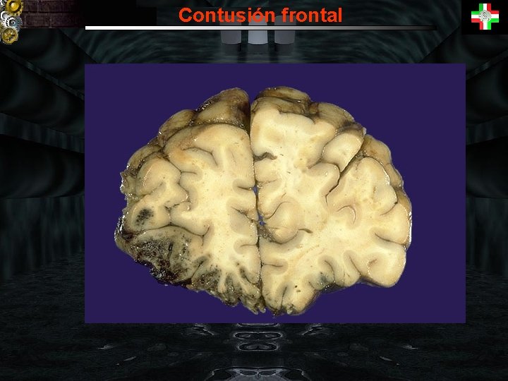 Contusión frontal 