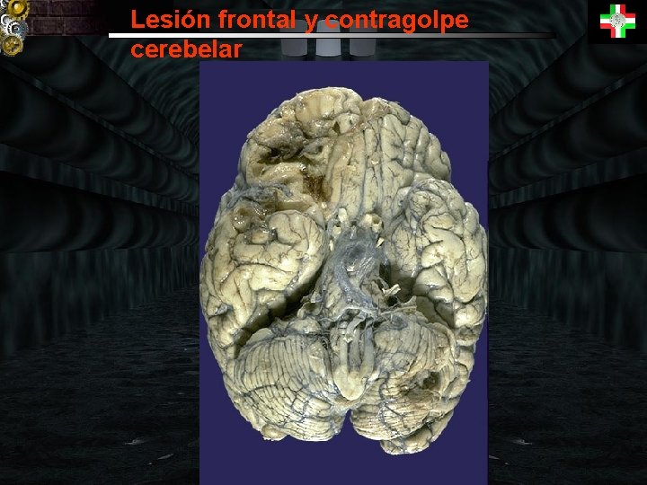 Lesión frontal y contragolpe cerebelar 