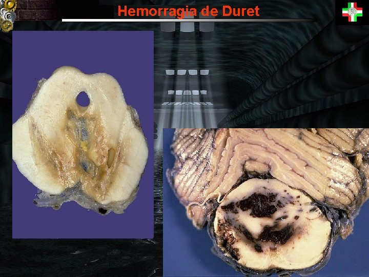 Hemorragia de Duret 