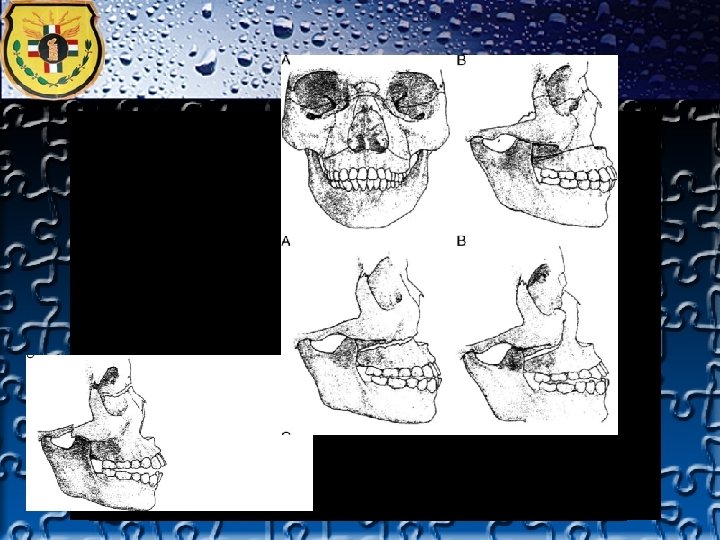 TRAUMA FACIAL 