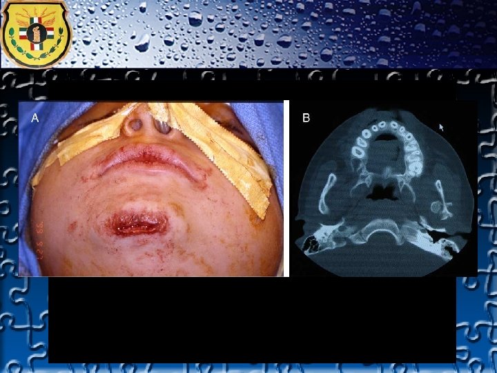 TRAUMA FACIAL 