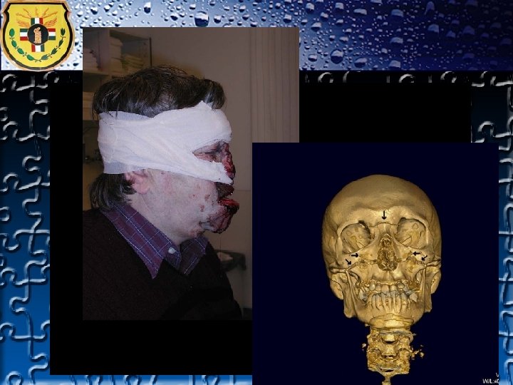 TRAUMA FACIAL TRAUMA FACIAL