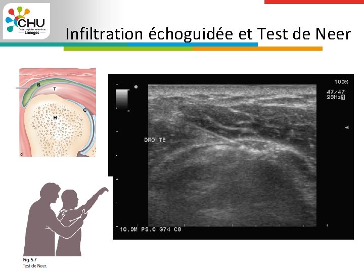 Infiltration échoguidée et Test de Neer 