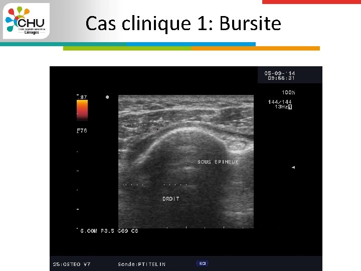 Cas clinique 1: Bursite 