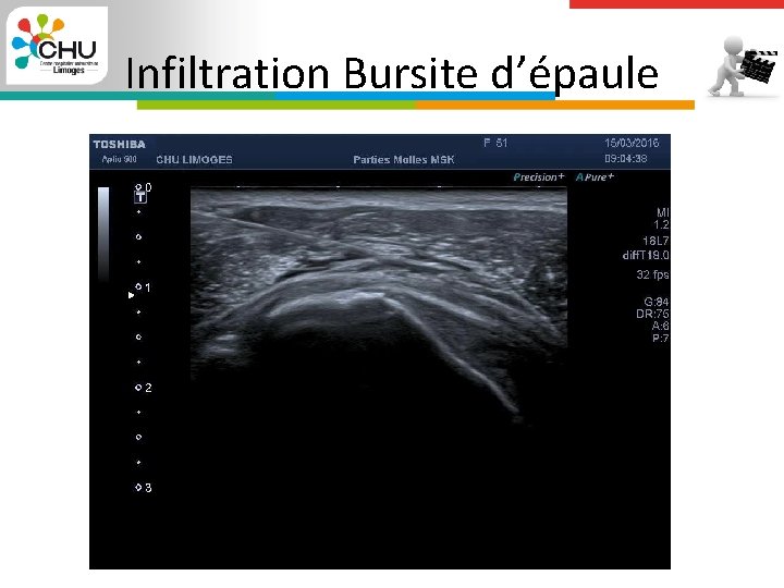 Infiltration Bursite d’épaule 