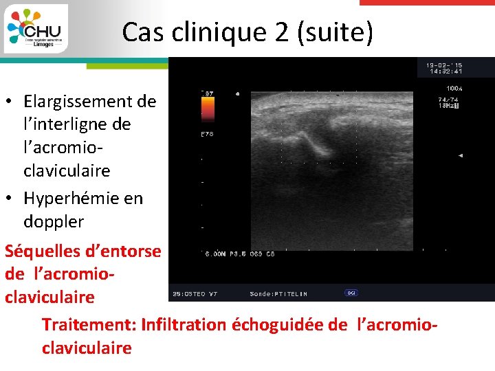 Cas clinique 2 (suite) • Elargissement de l’interligne de l’acromioclaviculaire • Hyperhémie en doppler