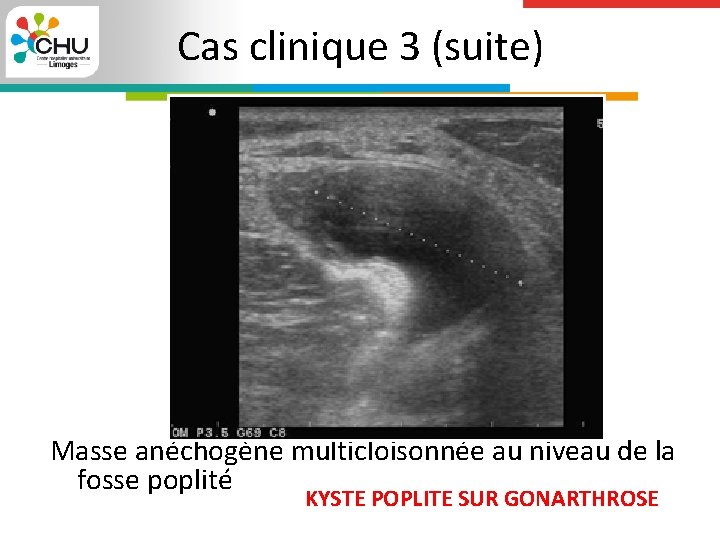 Cas clinique 3 (suite) Masse anéchogène multicloisonnée au niveau de la fosse poplité KYSTE