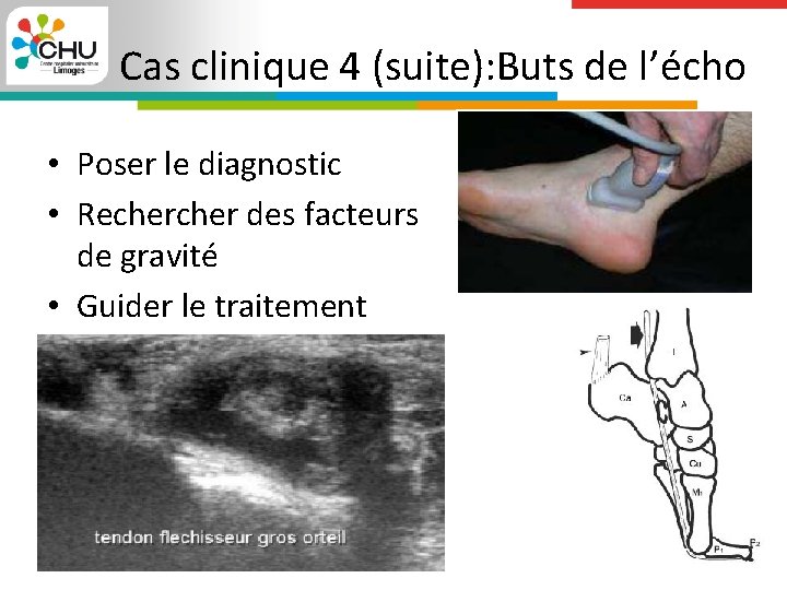 Cas clinique 4 (suite): Buts de l’écho • Poser le diagnostic • Recher des