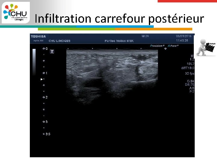 Infiltration carrefour postérieur 