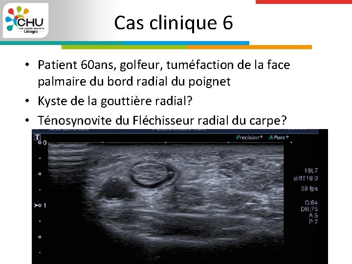 Cas clinique 6 • Patient 60 ans, golfeur, tuméfaction de la face palmaire du