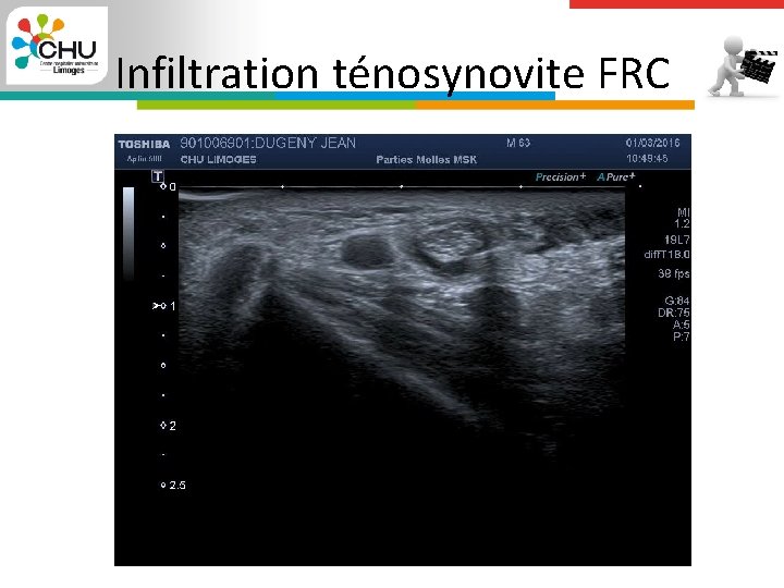 Infiltration ténosynovite FRC 