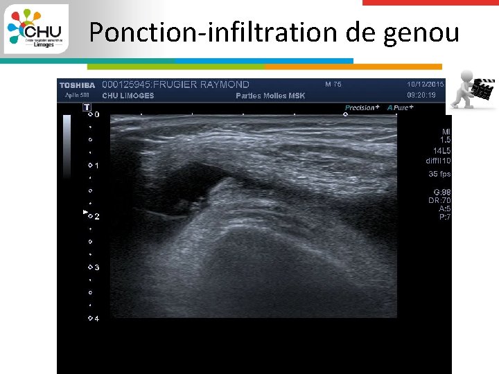 Ponction-infiltration de genou 