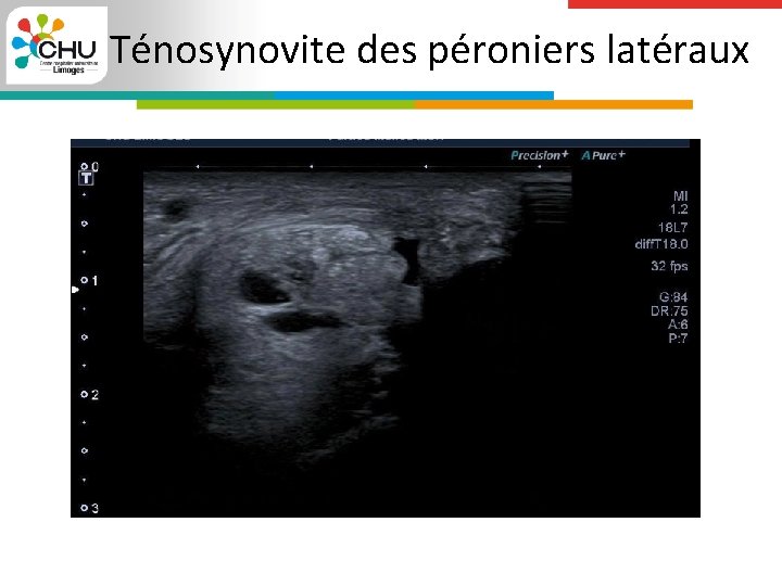 Ténosynovite des péroniers latéraux 