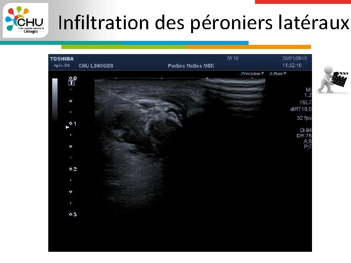 Infiltration des péroniers latéraux 