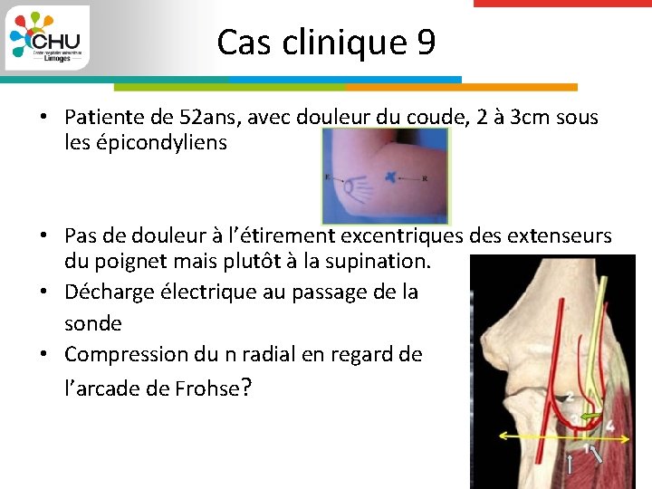 Cas clinique 9 • Patiente de 52 ans, avec douleur du coude, 2 à