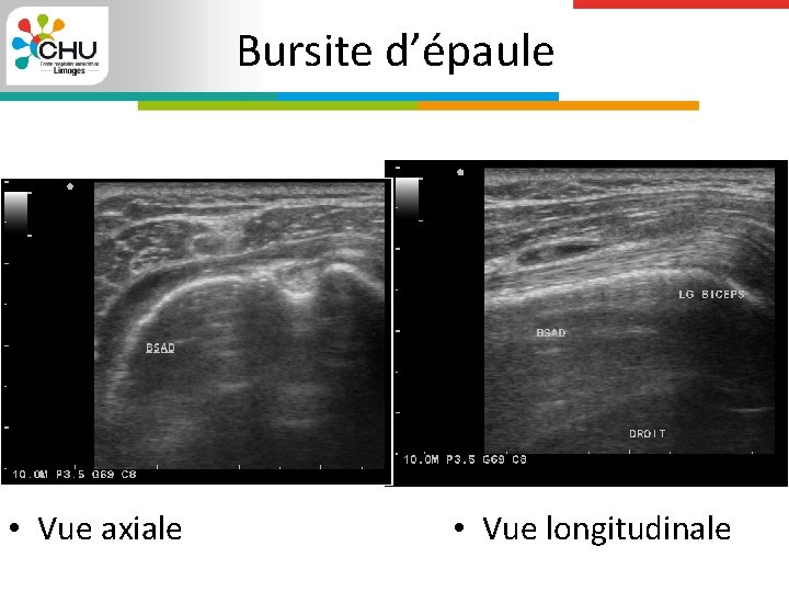 Bursite d’épaule • Vue axiale • Vue longitudinale 