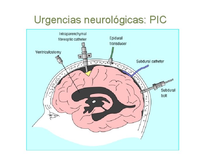 Urgencias neurológicas: PIC 