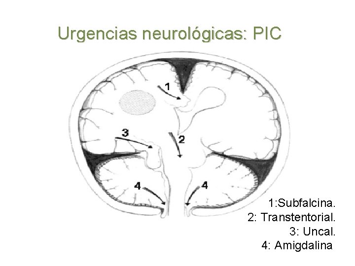 Urgencias neurológicas: PIC 1: Subfalcina. 2: Transtentorial. 3: Uncal. 4: Amigdalina 