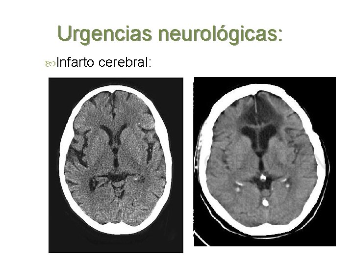 Urgencias neurológicas: Infarto cerebral: 