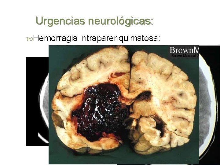Urgencias neurológicas: Hemorragia intraparenquimatosa: 