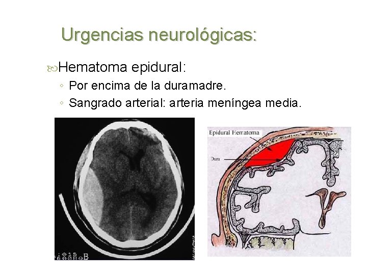 Urgencias neurológicas: Hematoma epidural: ◦ Por encima de la duramadre. ◦ Sangrado arterial: arteria