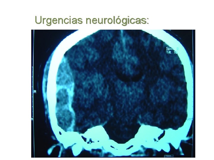 Urgencias neurológicas: 