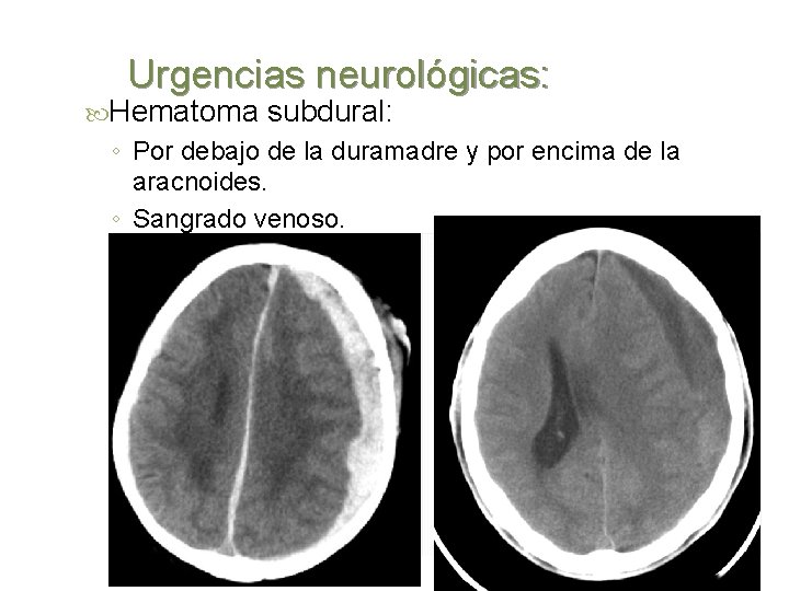 Urgencias neurológicas: Hematoma subdural: ◦ Por debajo de la duramadre y por encima de