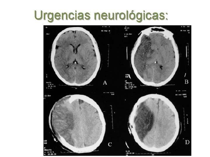 Urgencias neurológicas: 