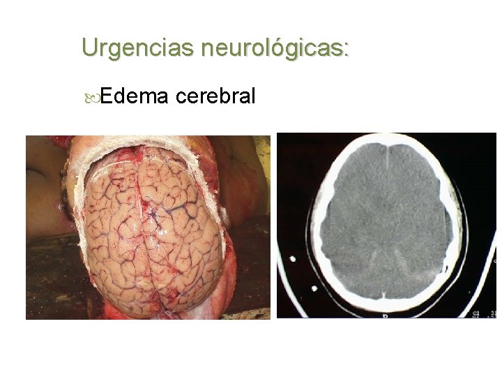 Urgencias neurológicas: Edema cerebral 