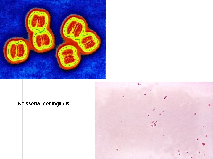 Neisseria meningitidis 