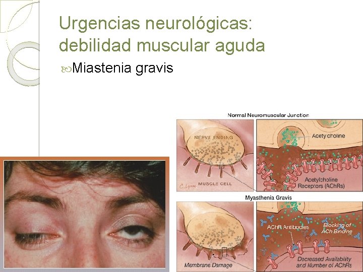 Urgencias neurológicas: debilidad muscular aguda Miastenia gravis 