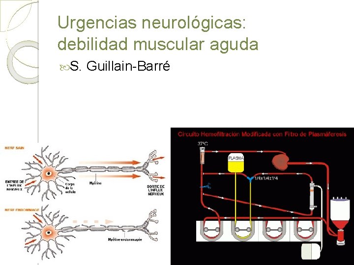 Urgencias neurológicas: debilidad muscular aguda S. Guillain-Barré 