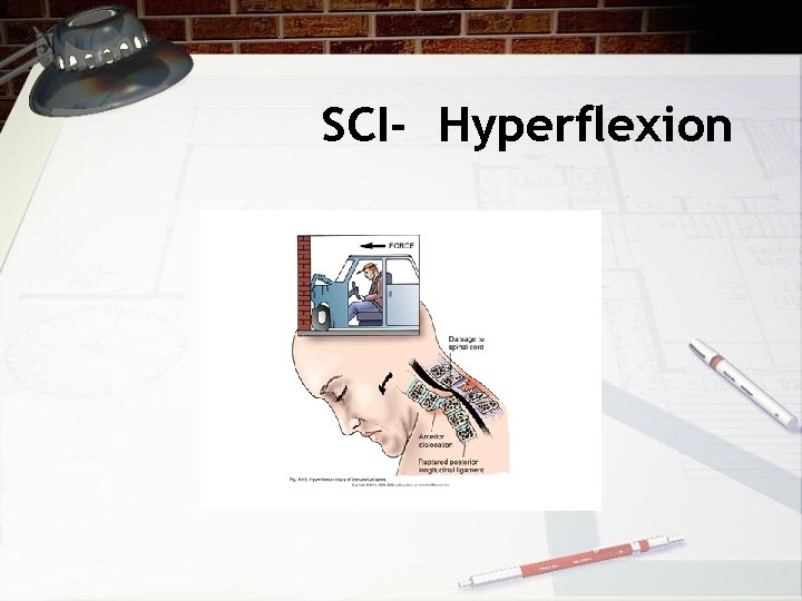 SCI- Hyperflexion 