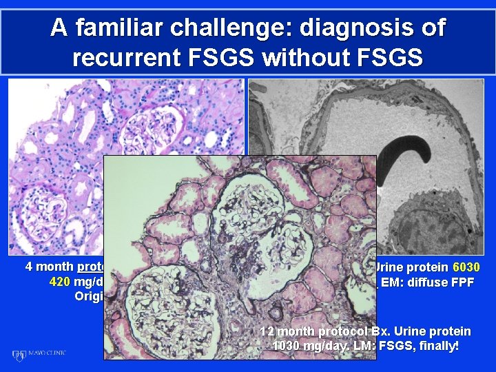 A familiar challenge: diagnosis of recurrent FSGS without FSGS 4 month protocol Bx. Urine