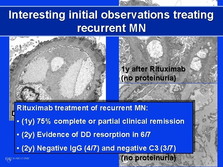 Interesting initial observations treating recurrent MN 1 y after Rituximab (no proteinuria) Rituximab treatment